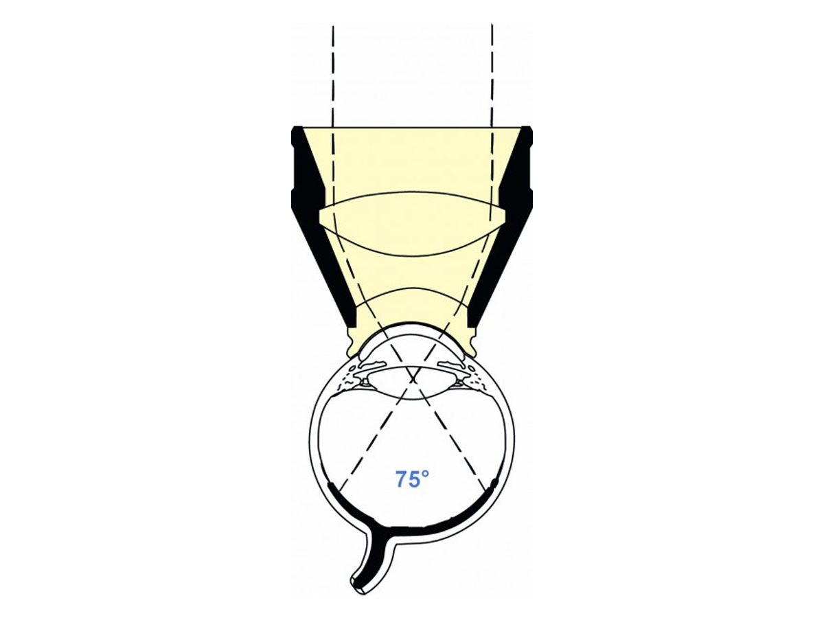Lentille Mainster à fort grossissement - 1 pc