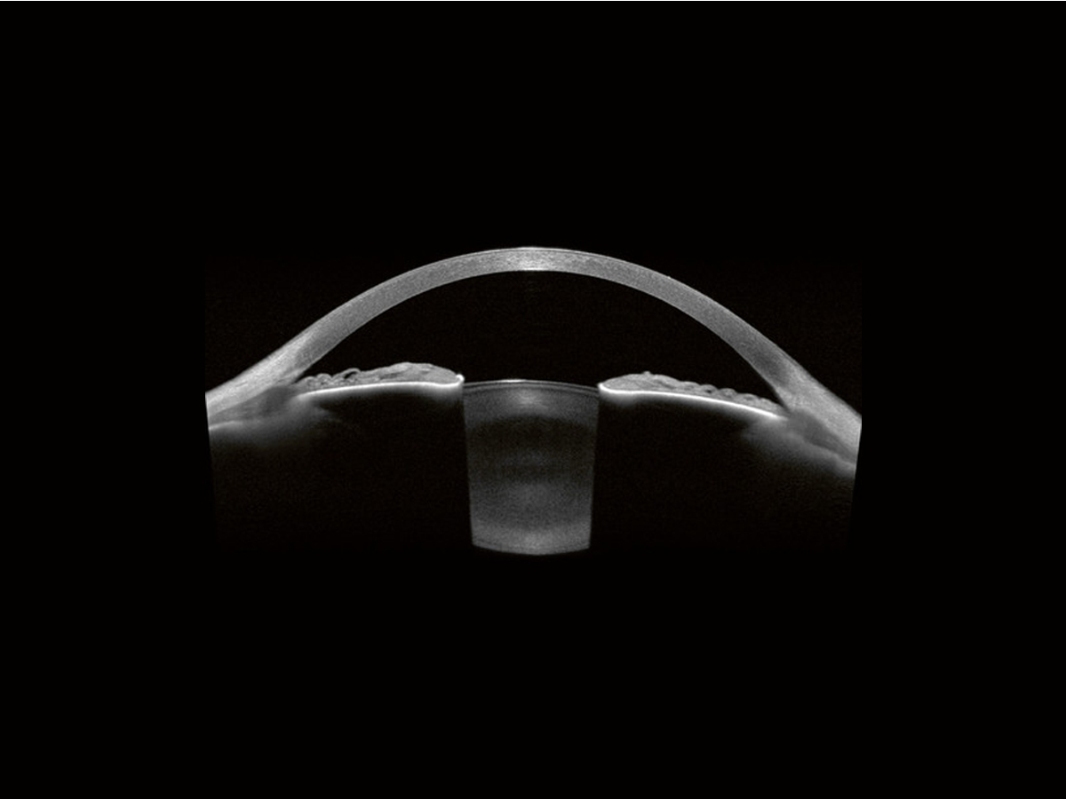 Anterion Multimodal Imaging Platform