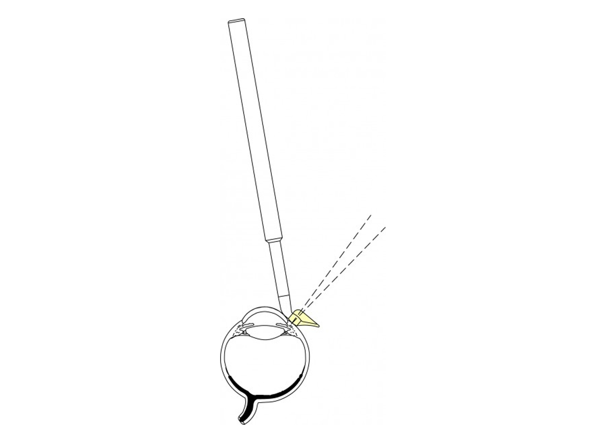 Lentille de suture Hoskins en nylon - 3 mm - 1 pc