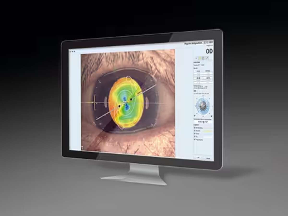 Eyestar 900 inclusief Cataract Suite