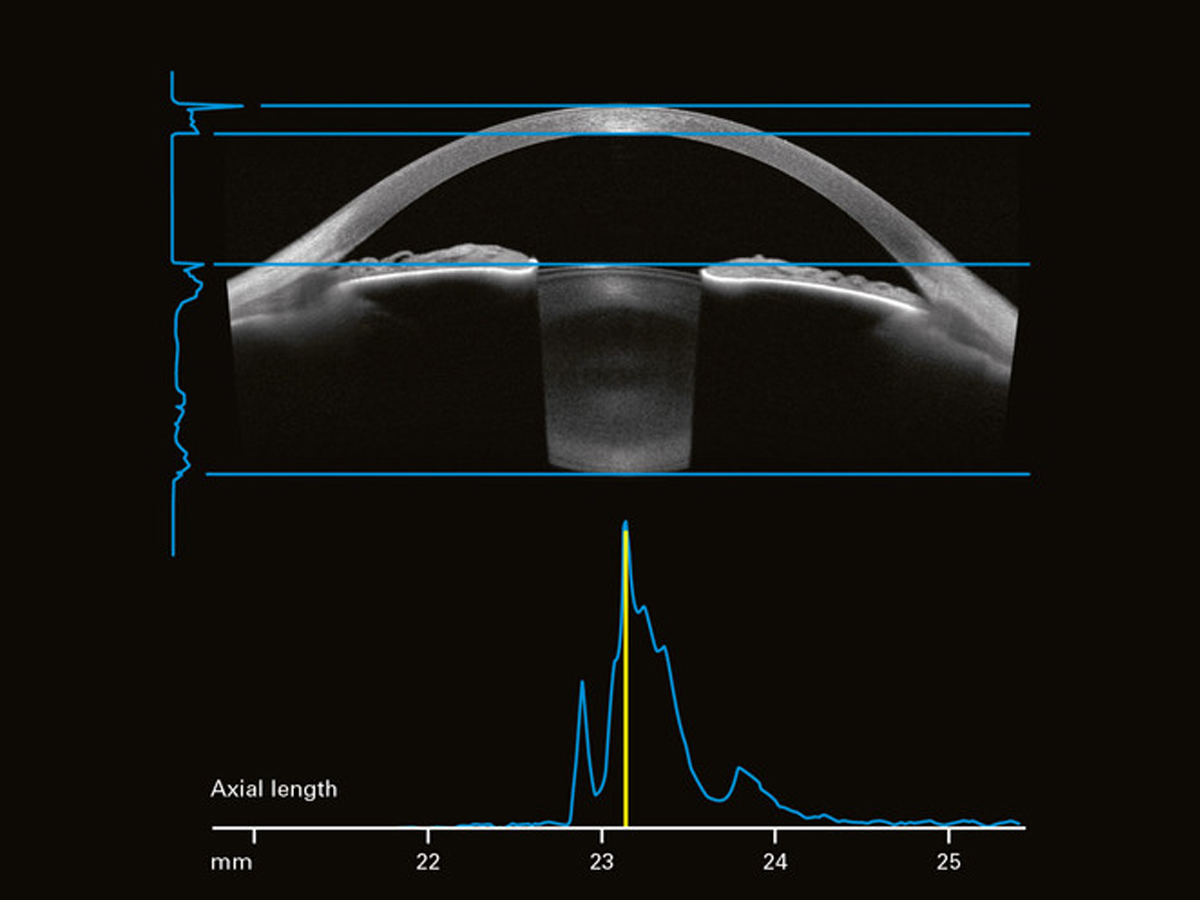 Anterion Multimodal Imaging Platform