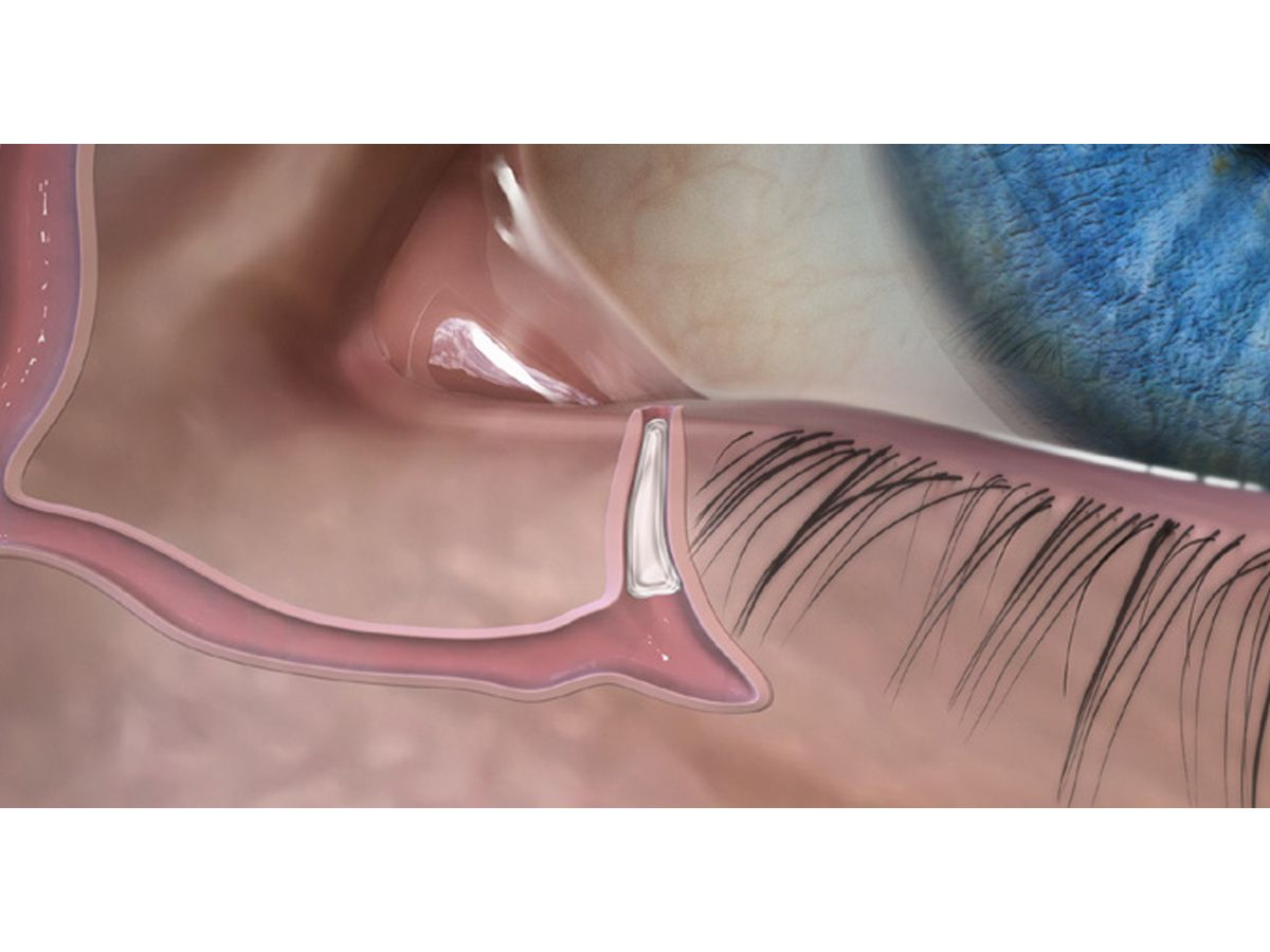 FORM FIT® Hydrogel Canaliculus Plug - 0,3 mm - 1 x 2 st