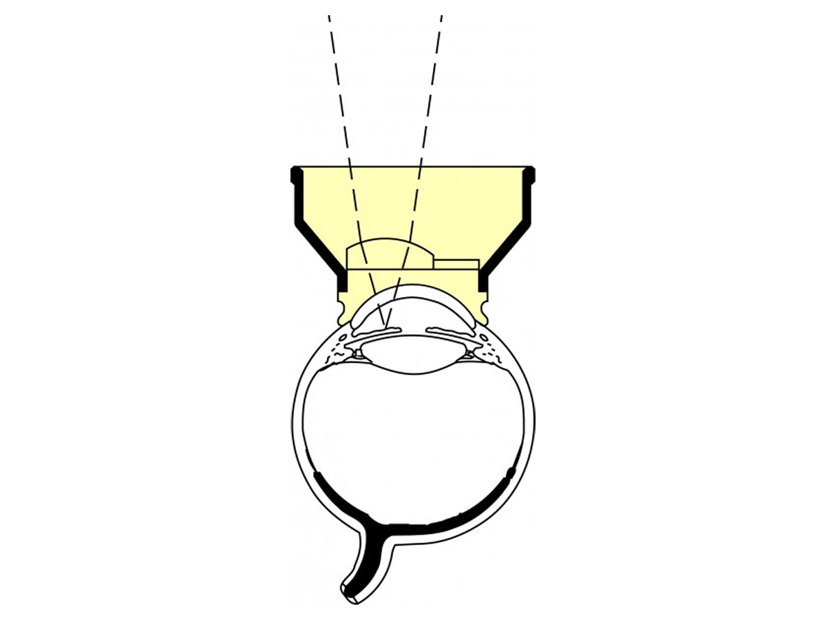 Abraham Iridectomie lens - YAG laser - 1 st