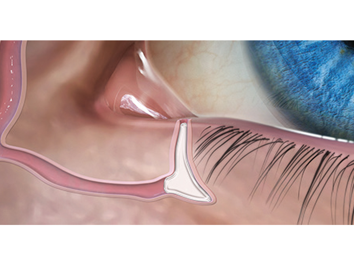 FORM FIT® Hydrogel Canaliculus Plug - 0,3 mm - 1 x 2 st