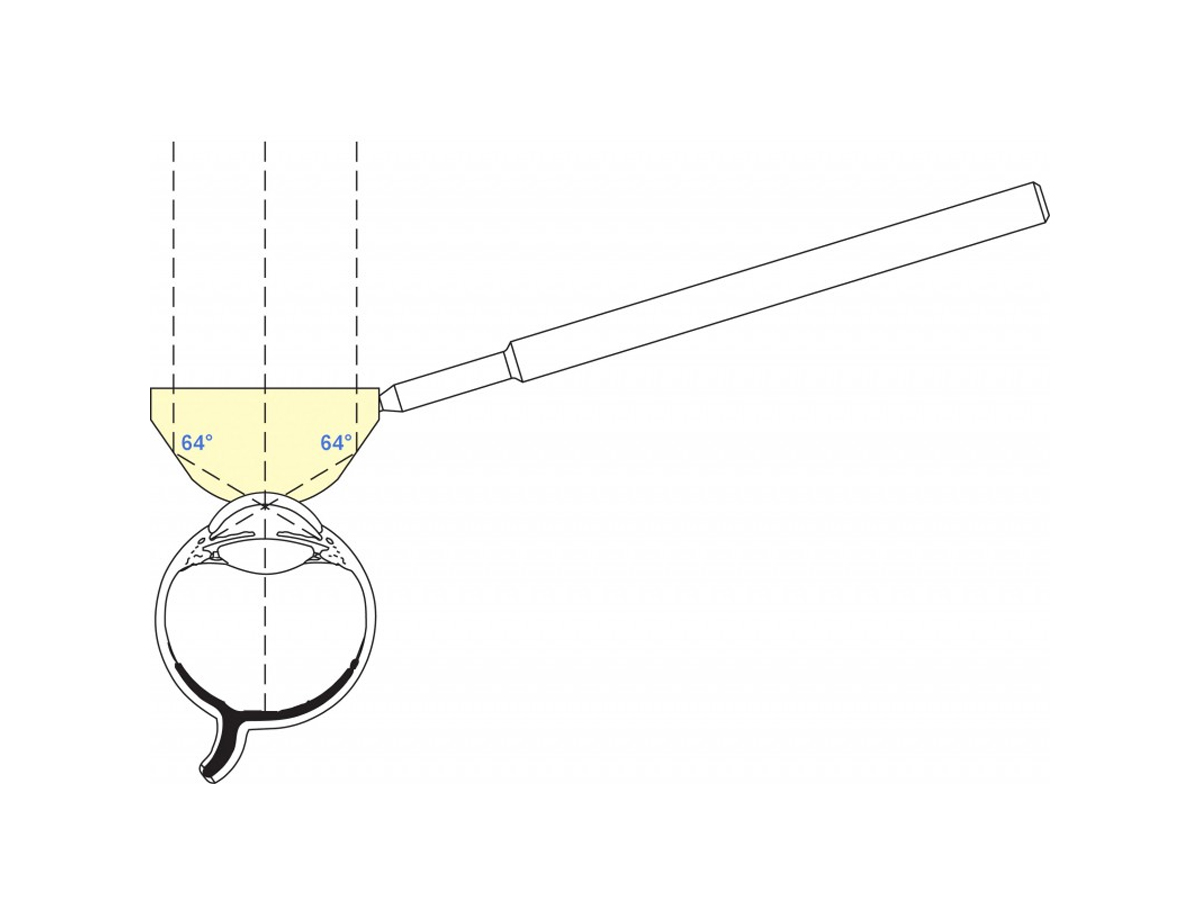 Gonioprisme chirurgical et diagnostique Posner avec poignée ergonomique - Noir - 1 pc