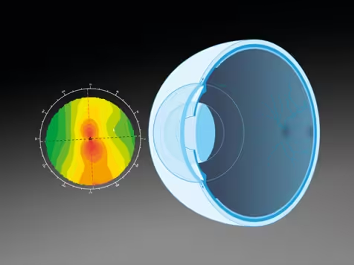 Eyestar 900 inclusief Cataract Suite