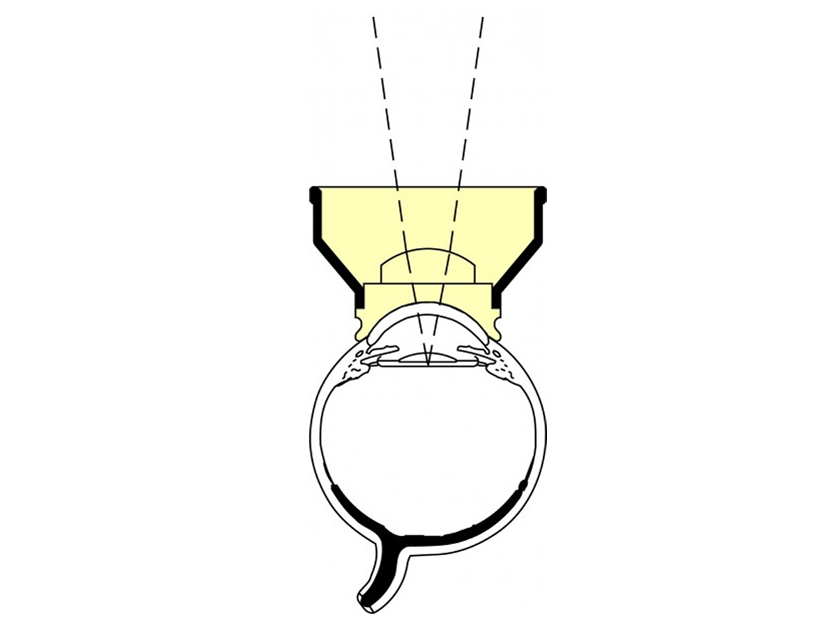 Lentille de capsulotomie d'Abraham - laser YAG - 1 pc