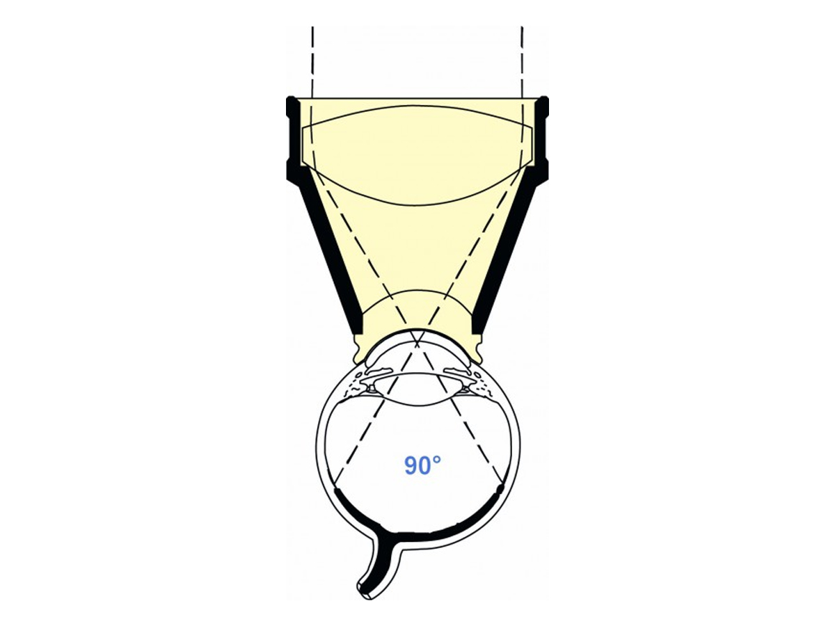 Mainster Standaard lens - Focaal/rasterlaser - 1 st