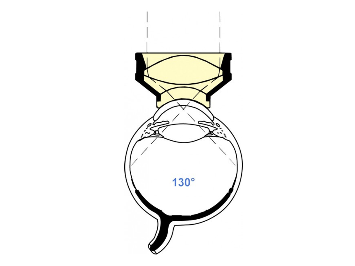 Lentille de vitrectomie à grand champ de Landers - 1 pc