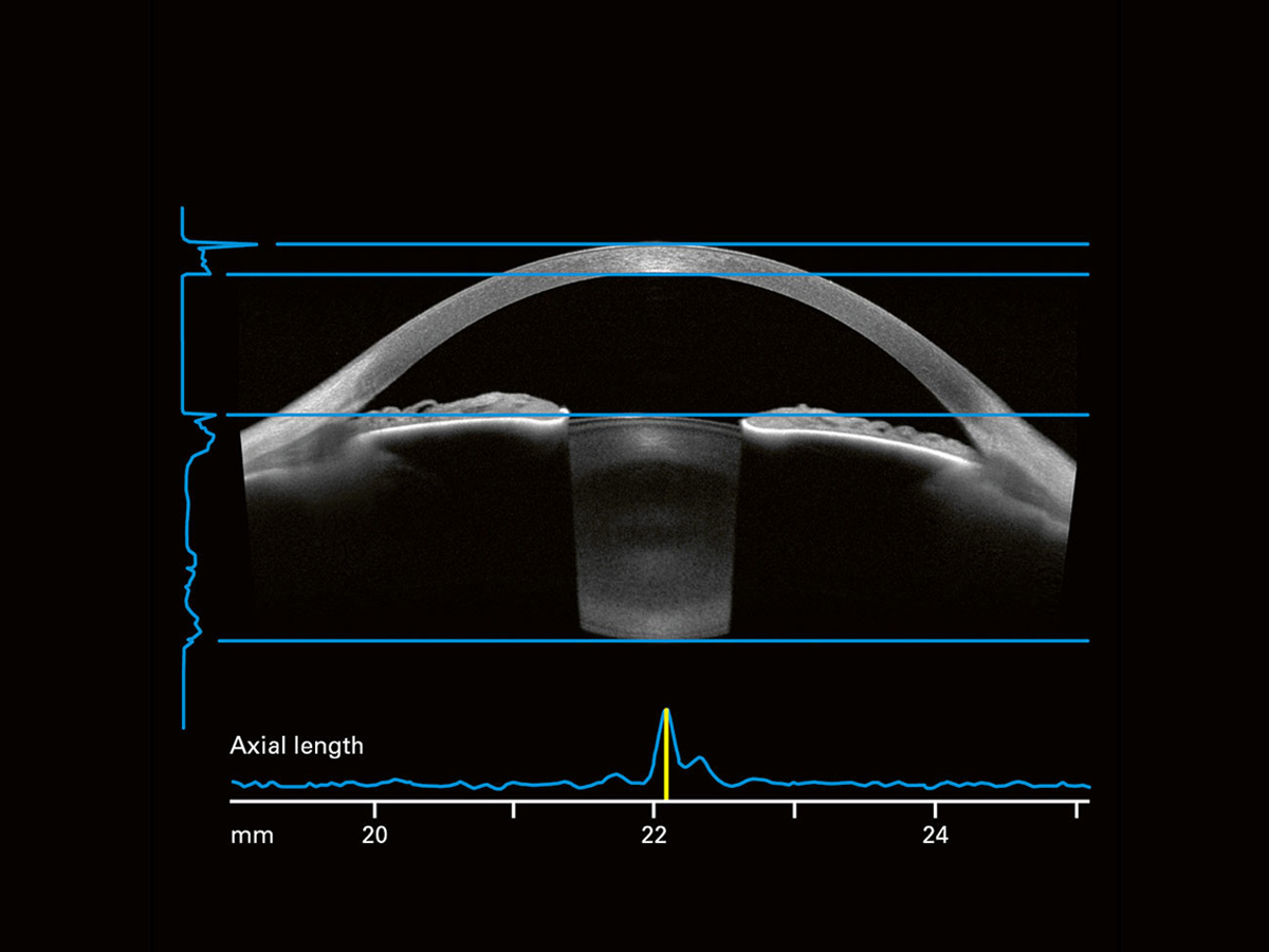 Anterion Multimodal Imaging Platform