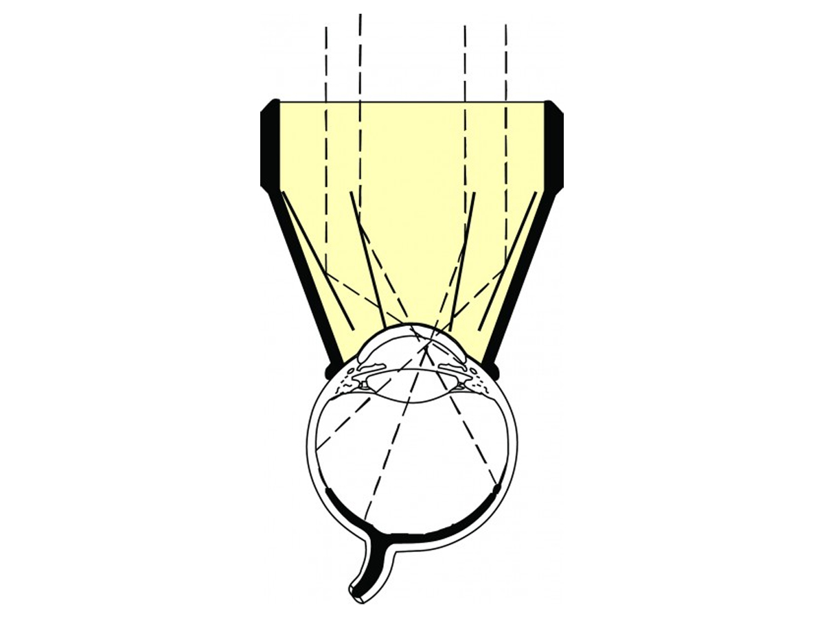 Karickhoff lentille laser - 18 mm - 1 pc