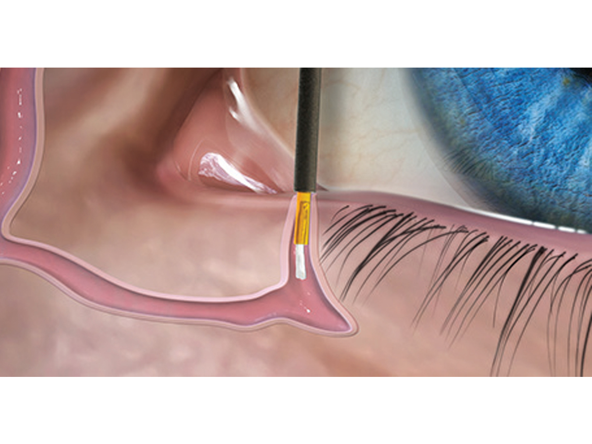FORM FIT® Hydrogel Canaliculus Plug - 0,3 mm - 1 x 2 st